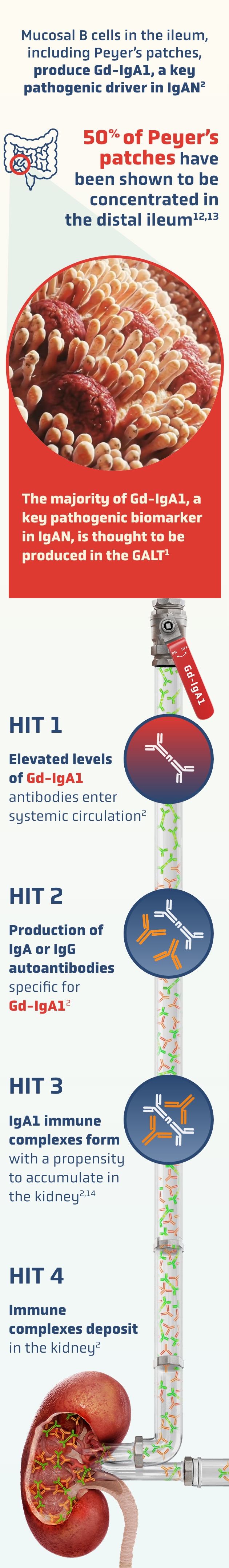 Circular graphic labeled HIT 1 showing Gd-IgA1 antibodies entering systemic circulation in early-stage IgAN.