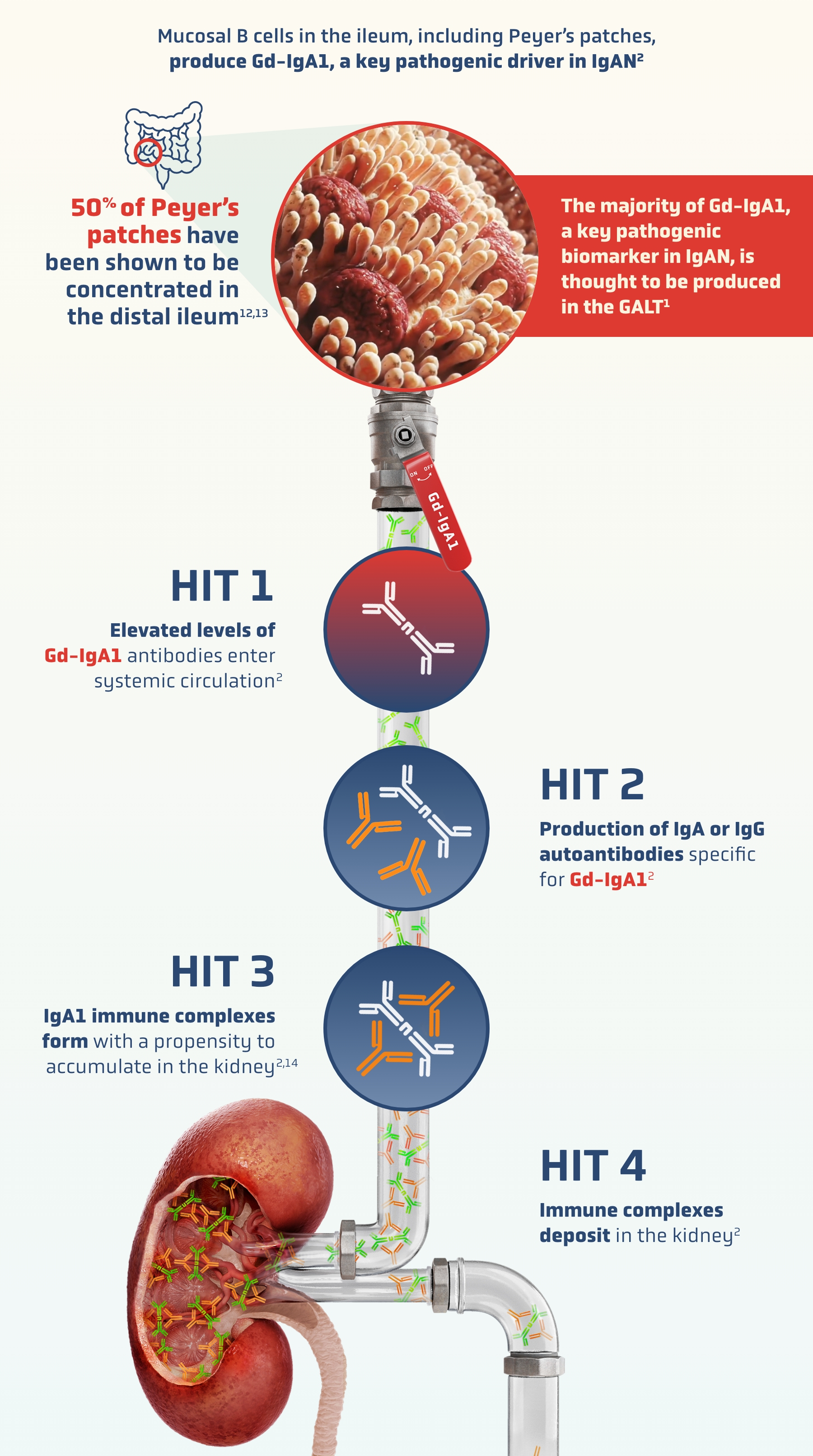 Circular graphic labeled HIT 1 showing Gd-IgA1 antibodies entering systemic circulation in early-stage IgAN.